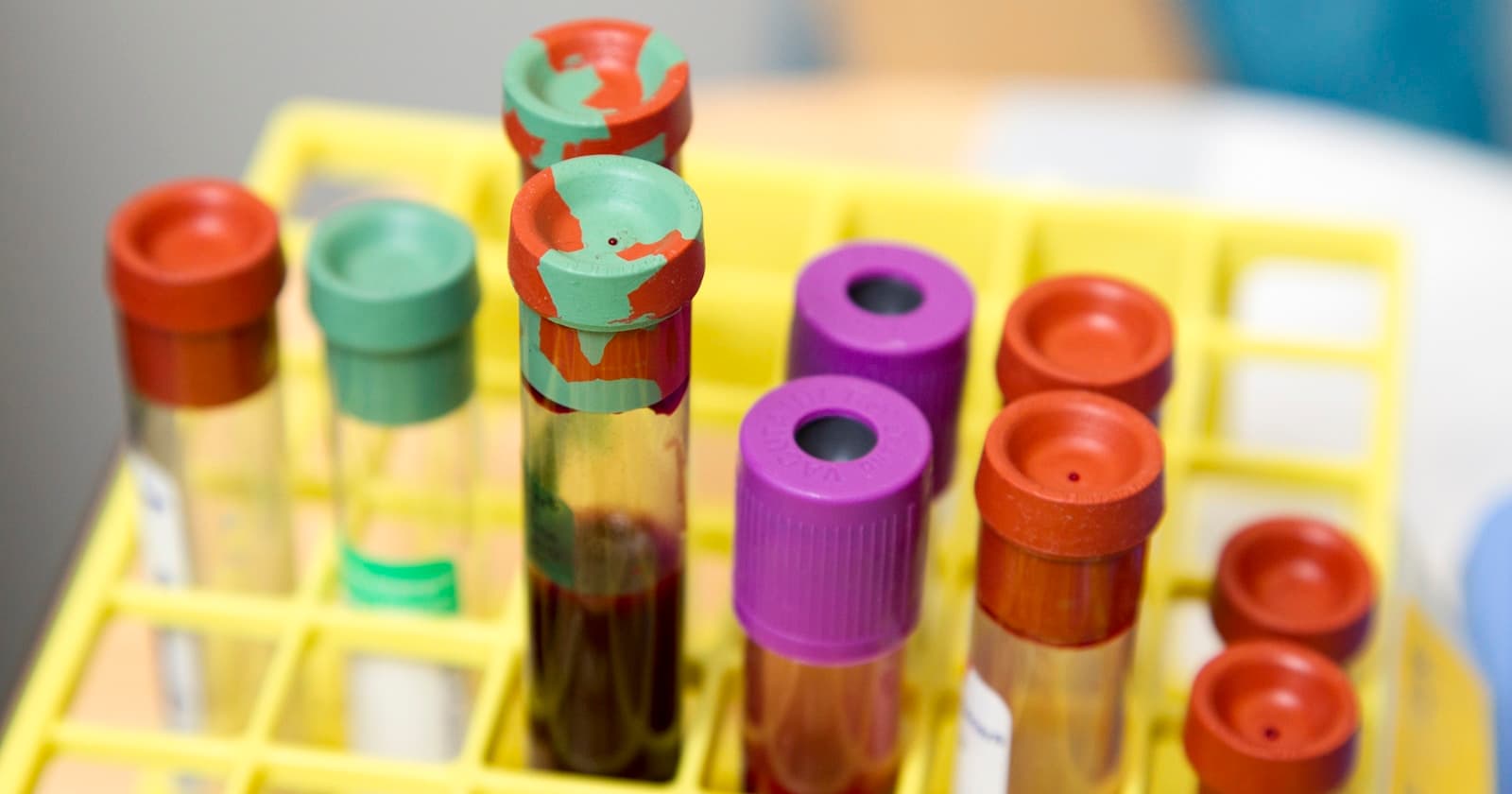 Epruvete sa uzorcima krvi za laboratorijsku analizu